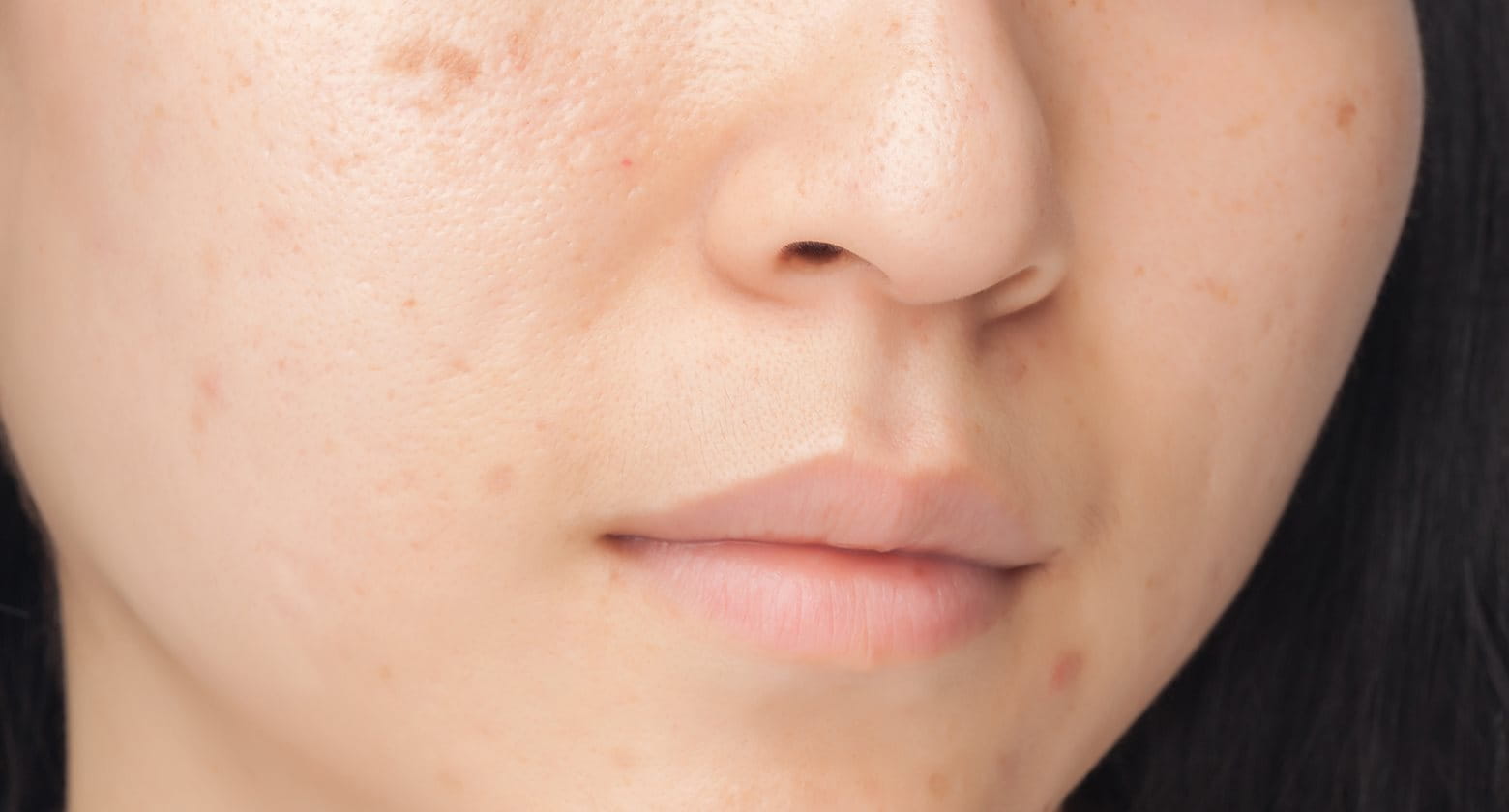 how reduce inflammation acne Eucerin consequences marks Pimple of  acne the