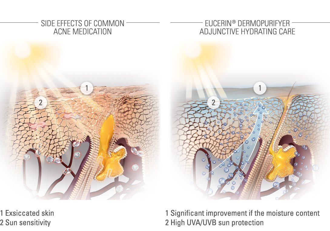 Eucerin: Acne-prone skin | Medicinal treatments for the ...