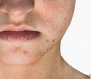 Image result for acne prone skin