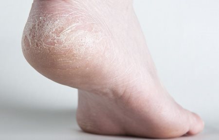 Foot with cracked soles